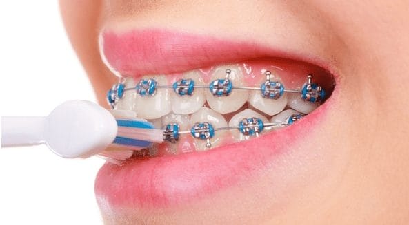 The Essential Guide to Maintaining Good Oral Hygiene with Braces ...